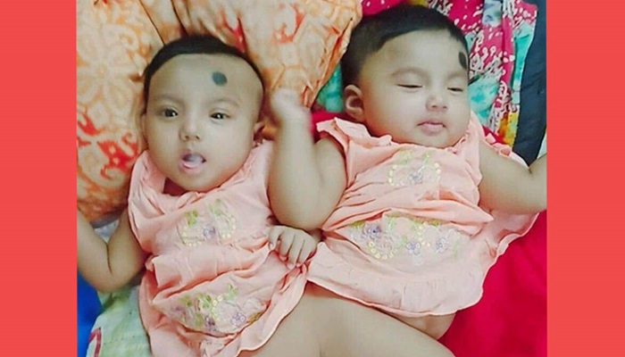 দেশে প্রথম আলাদা হচ্ছে মেরুদণ্ডে যুক্ত দুই শিশু