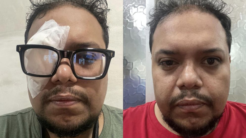 নিম্নমানের লেন্সে চোখের পর্দা ক্ষতিগ্রস্ত, হাসপাতালে শাওন মজুমদার