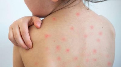 হাম হলে শিশুকে যেসব খাবার খাওয়াবেন