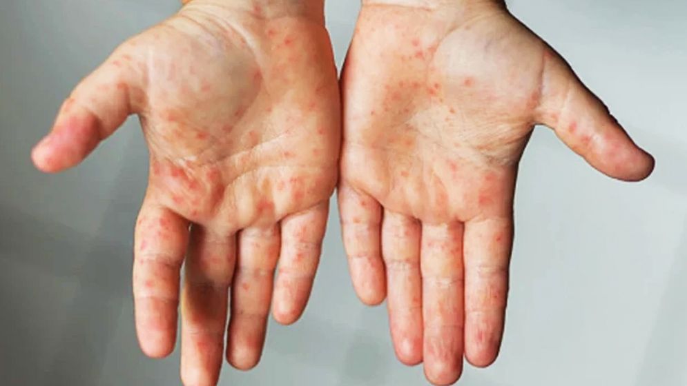 ২৪ ঘণ্টায় হামে ১২ শিশুর মৃত্যু, মোট মৃত্যু ১৩০