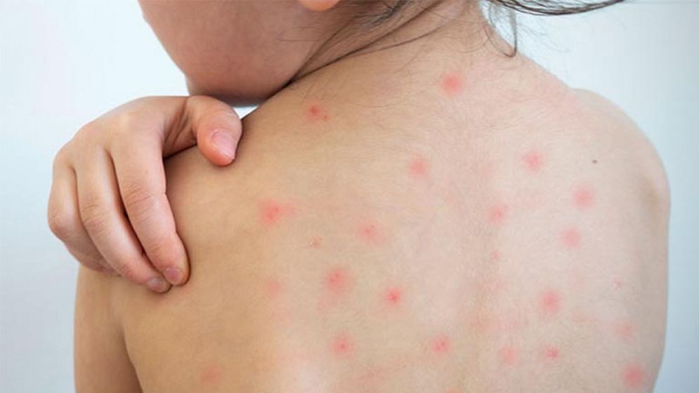 দেশে হামে আরো ৪ শিশুর মৃত্যু, আক্রান্ত ৬৮৫ জন