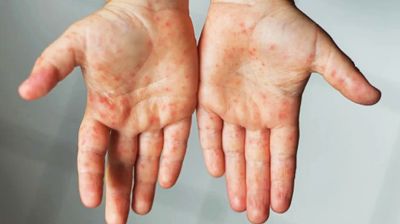 ২৪ ঘন্টায় হামে ১২ শিশুর মৃত্যু, মোট মৃত্যু ১৩০