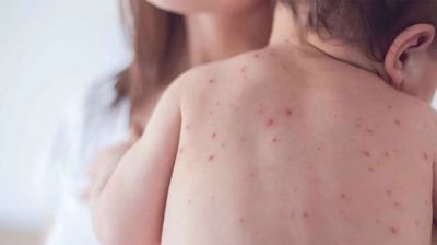 ময়মনসিংহে হামের উপসর্গে শিশুর মৃত্যু, ২৪ ঘণ্টায় ভর্তি ২৮