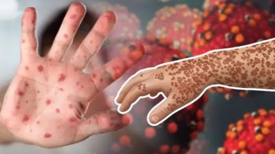 দেশে হাম ও উপসর্গে মৃত্যু ছাড়াল আড়াইশ