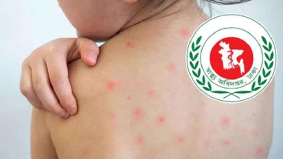 সারাদেশে হাম উপসর্গে আরো ৪ জনের মৃত্যু